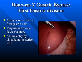 Roux-en-Y Gastric Bypass: First Gastric division Along lesser curve, at first gastric vein May use ultrasonic device/cautery Assure entry by visualizing posterior wall 