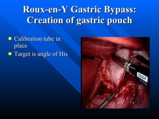 Roux-en-Y Gastric Bypass: Creation of gastric pouch Calibration tube in  place Target is angle of His 