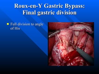 Roux-en-Y Gastric Bypass: Final gastric division Full division to angle of His 