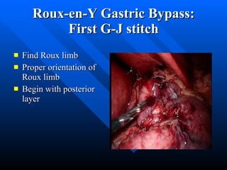 Roux-en-Y Gastric Bypass: First G-J stitch Find Roux limb Proper orientation of Roux limb Begin with posterior layer 
