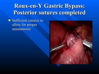 Roux-en-Y Gastric Bypass: Posterior sutures completed Sufficient sutures to allow for proper anastamosis 