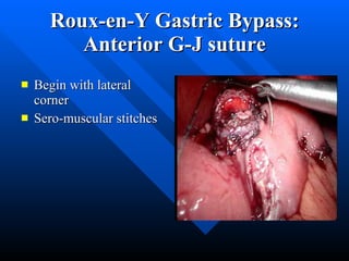 Roux-en-Y Gastric Bypass: Anterior G-J suture Begin with lateral corner Sero-muscular stitches 