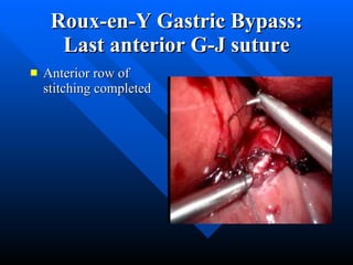 Roux-en-Y Gastric Bypass: Last anterior G-J suture Anterior row of stitching completed  