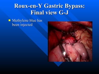 Roux-en-Y Gastric Bypass: Final view G-J Methylene blue has been injected 