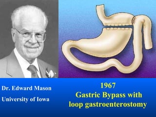 Dr. Edward Mason University of Iowa 1967 Gastric Bypass with  loop gastroenterostomy 