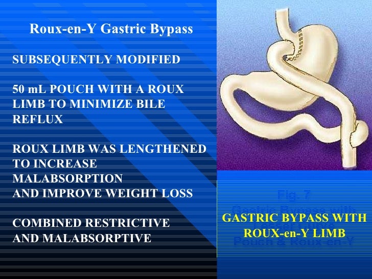 Gastroenterostomy And Weight Loss