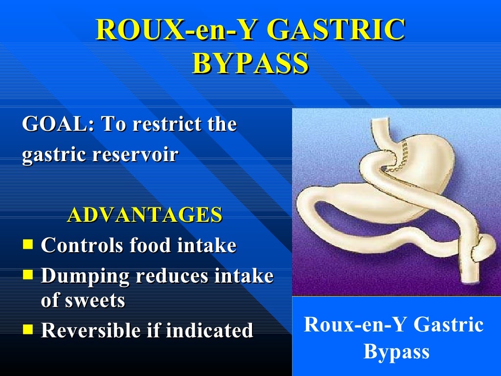 Laparoscopic Roux EnYGastric Bypass One Surgeon's Technique