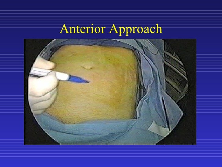 Laparoscopic Sigmoid Colon Resection for Diverticular Disease