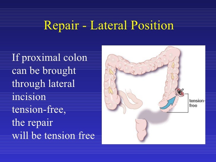 Laparoscopic Sigmoid Colon Resection for Diverticular Disease