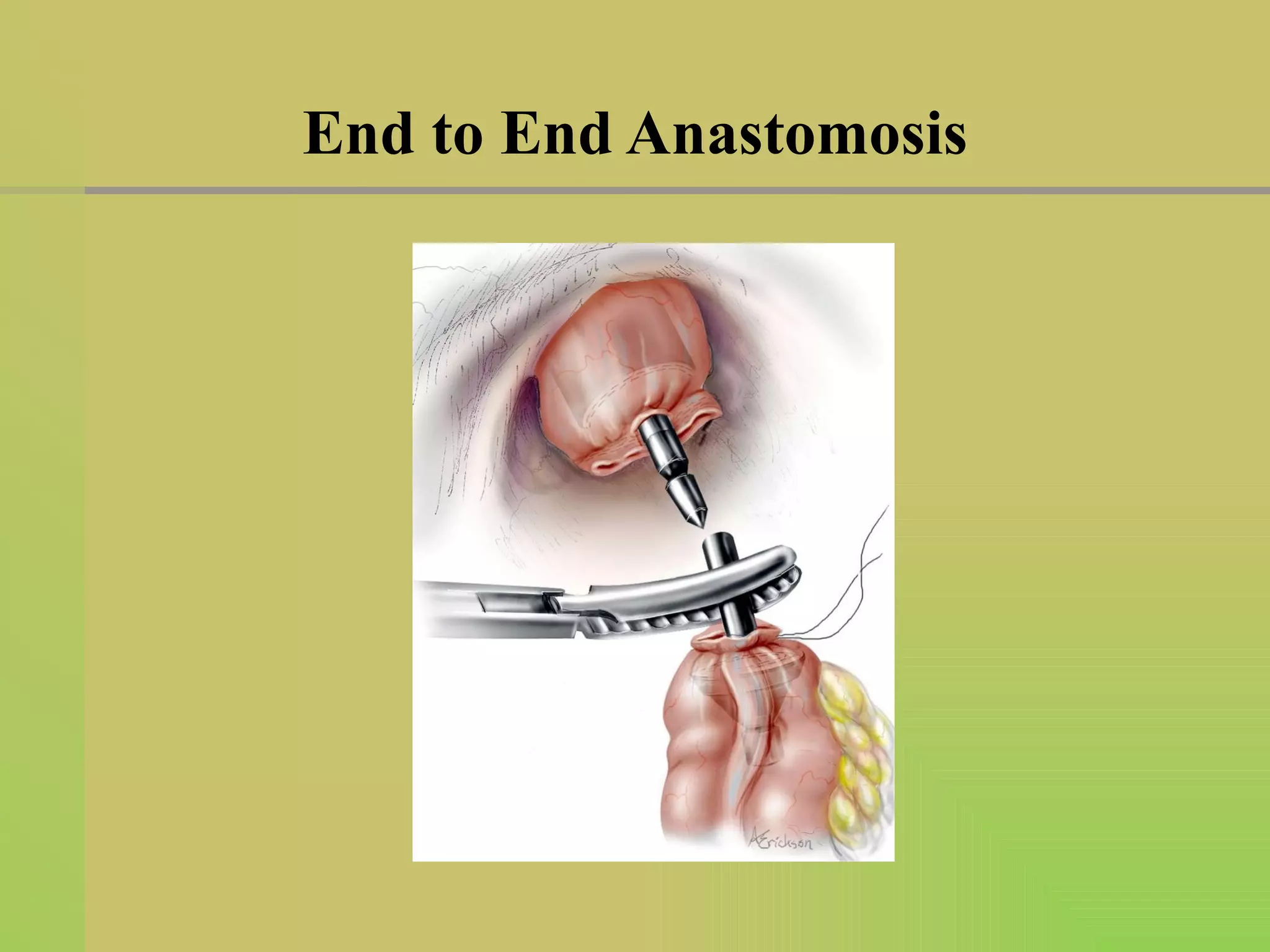 End to End Anastomosis 