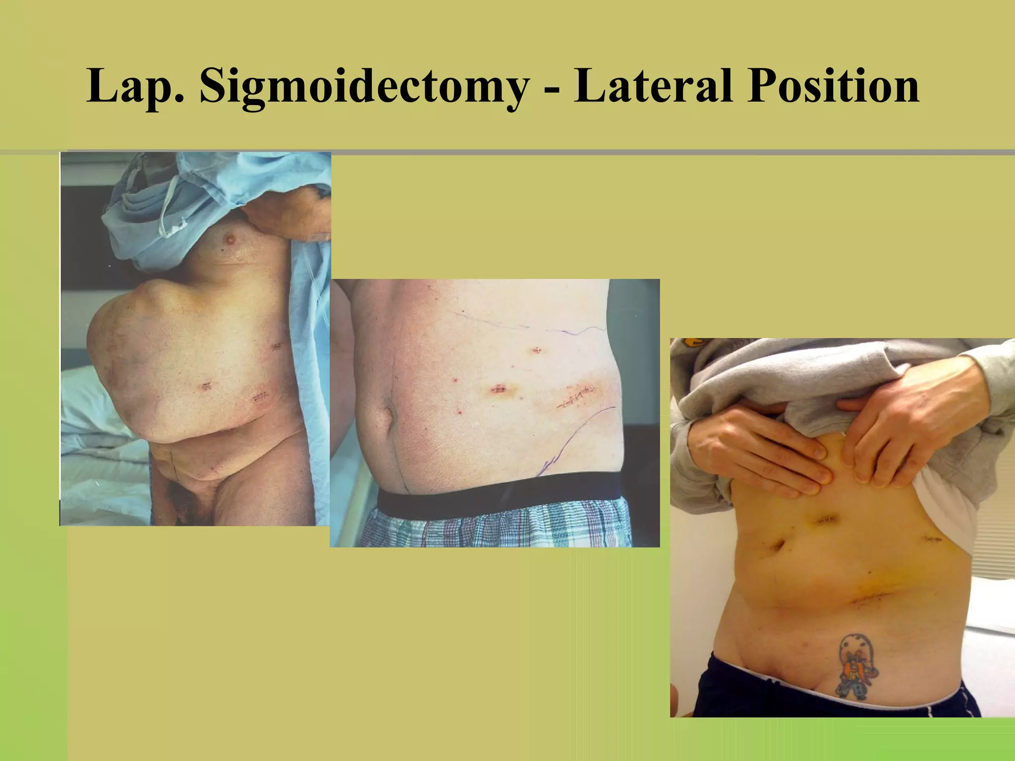 Lap. Sigmoidectomy - Lateral Position 