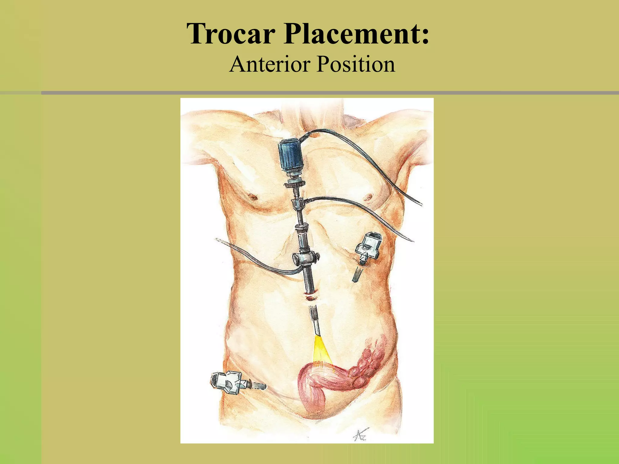 Trocar Placement:  Anterior Position 