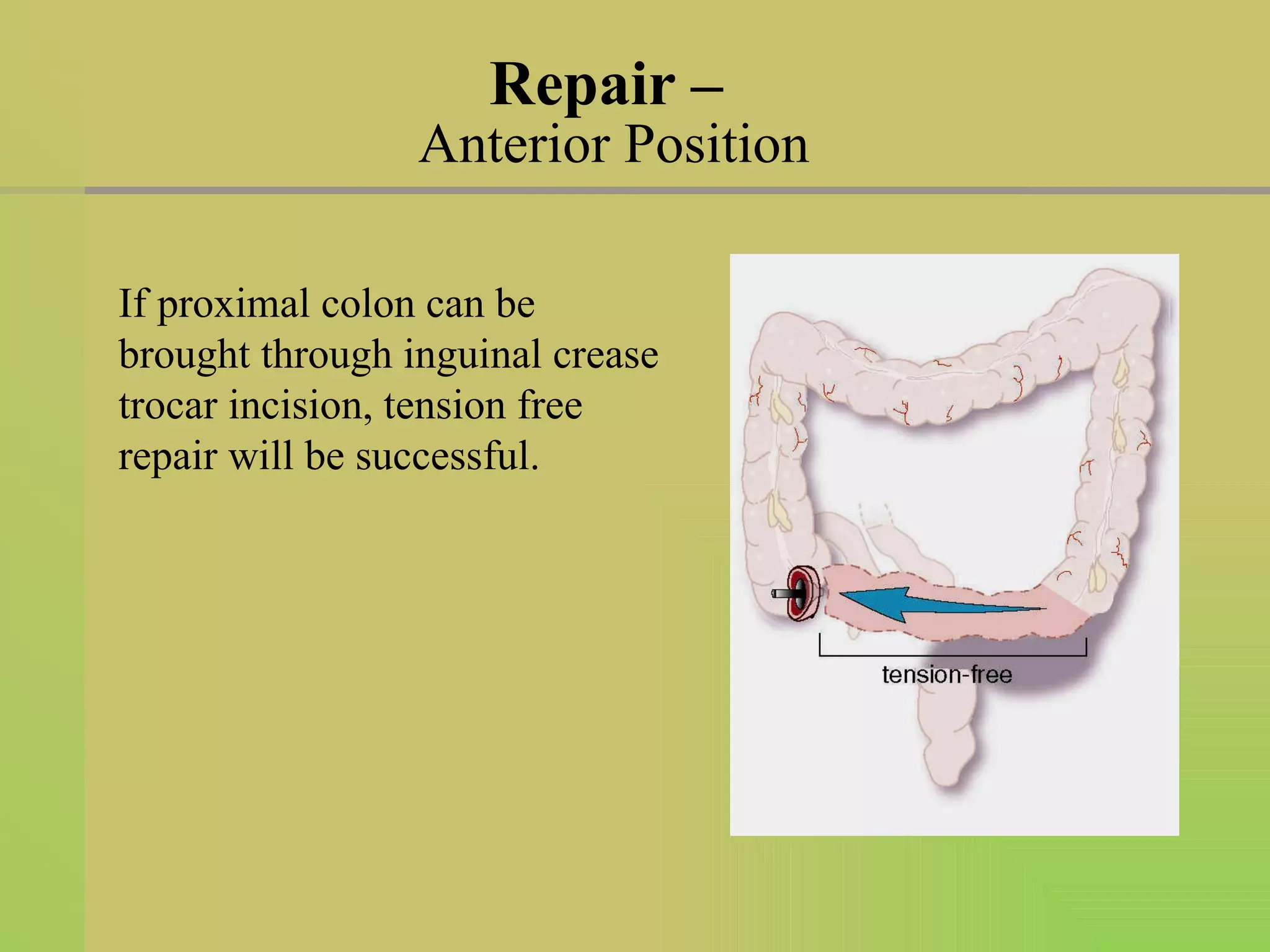 Repair –  Anterior Position If proximal colon can be brought through inguinal crease trocar incision, tension free repair will be successful. 