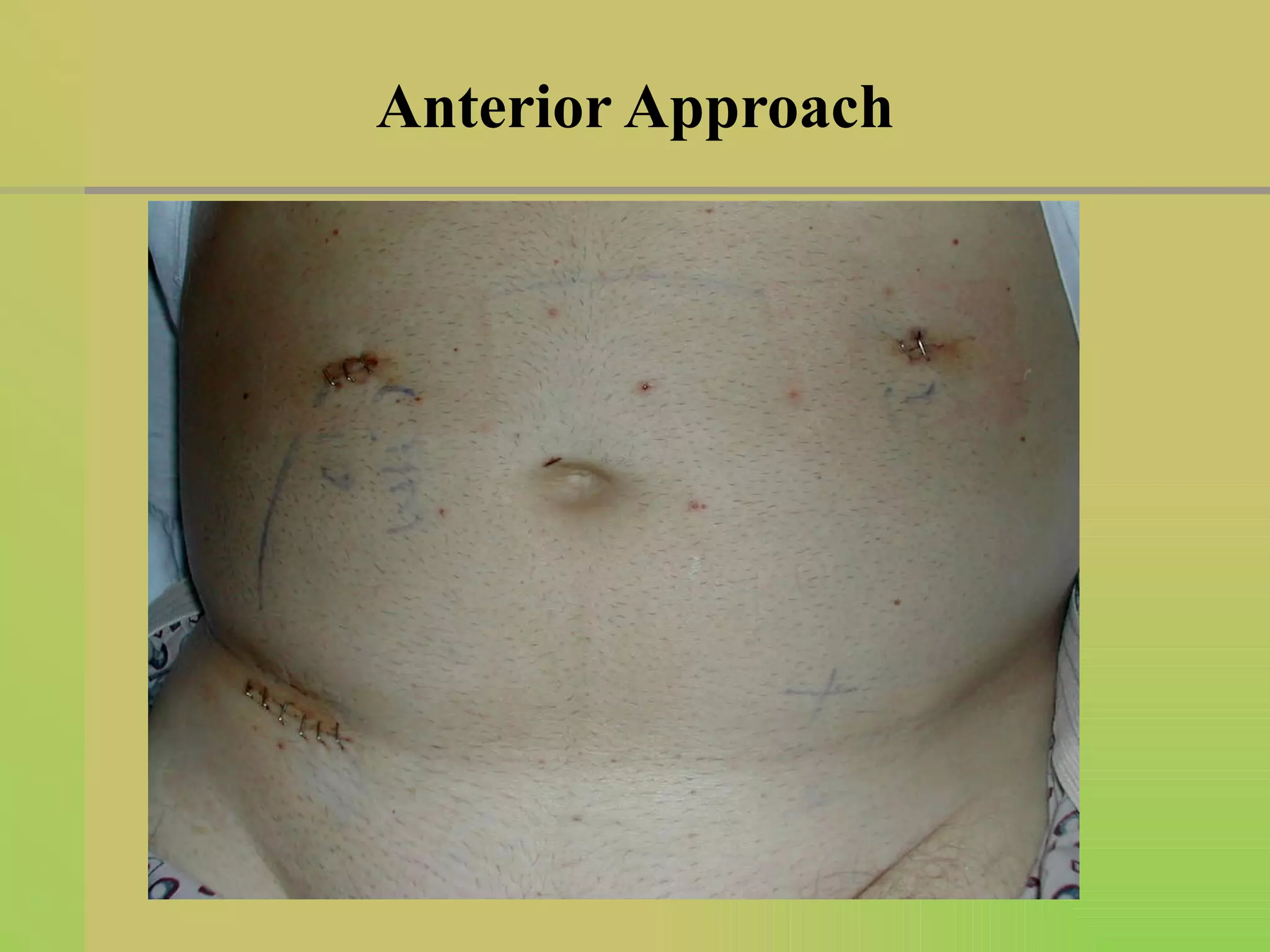 Anterior Approach 