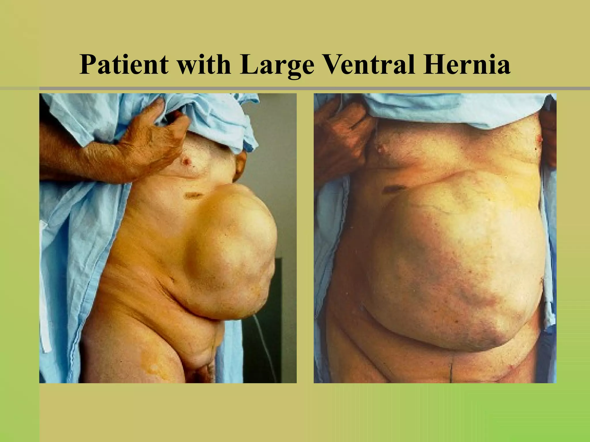Patient with Large Ventral Hernia 