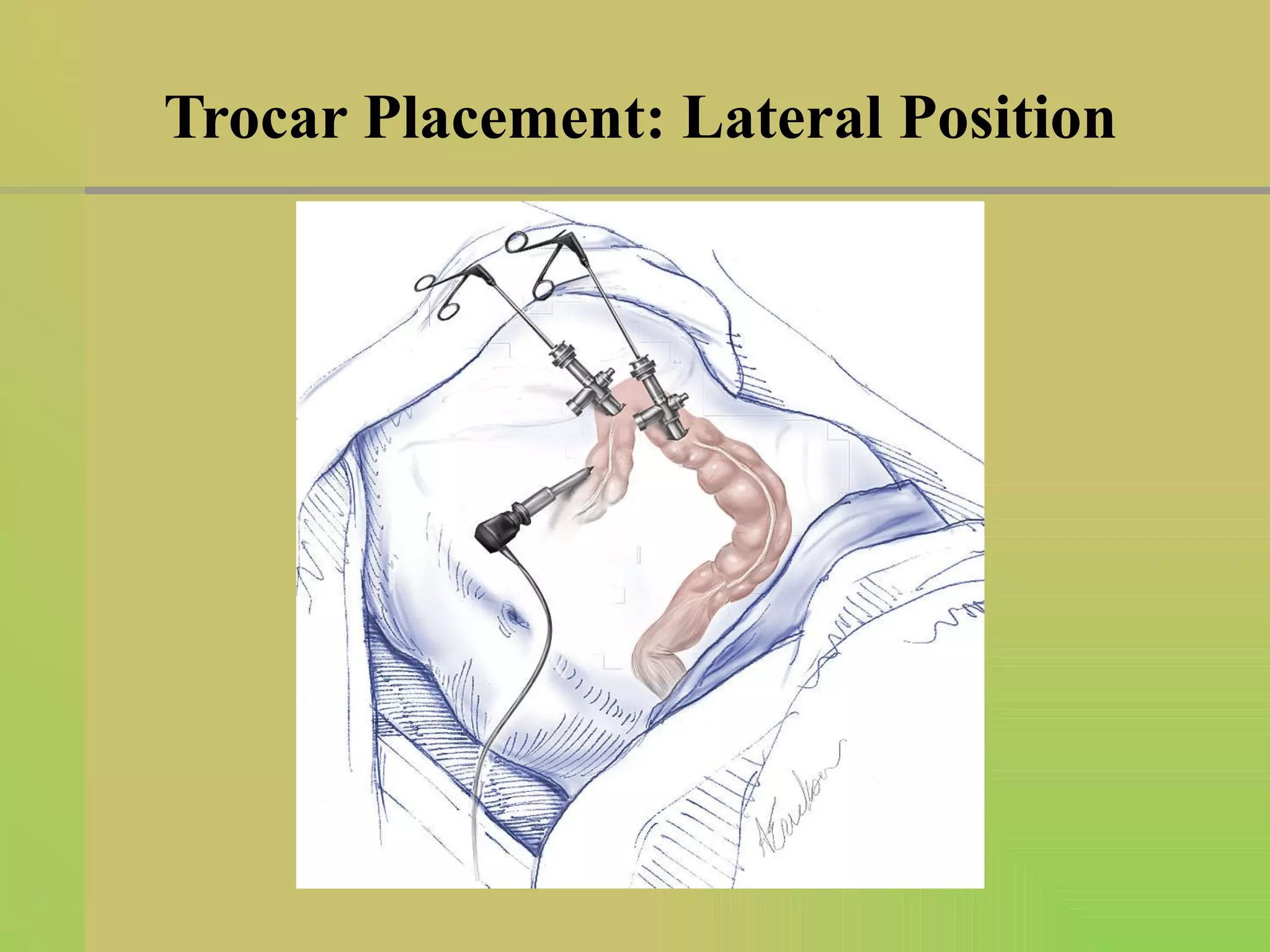 Trocar Placement: Lateral Position 