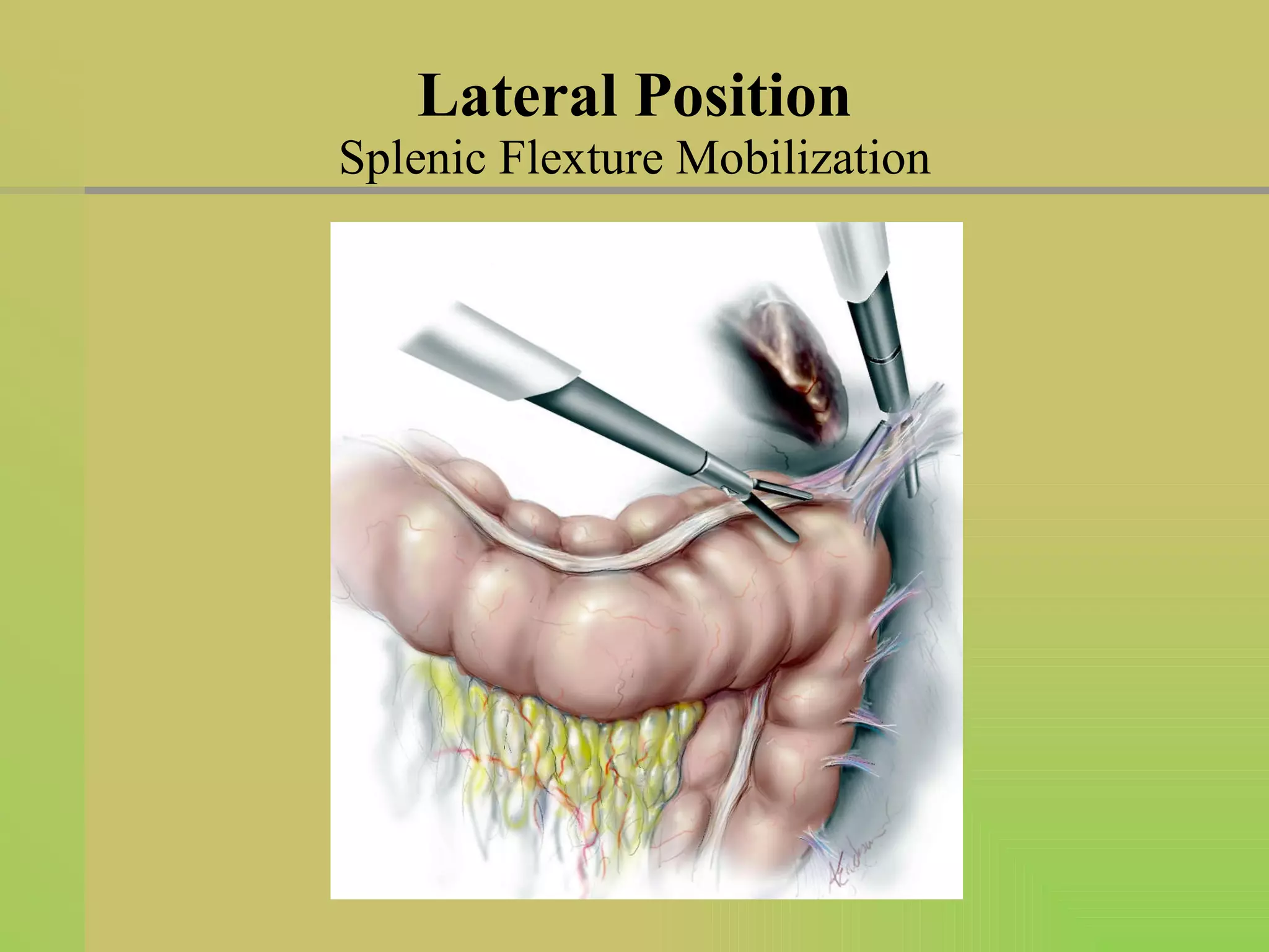 Lateral Position Splenic Flexture Mobilization 