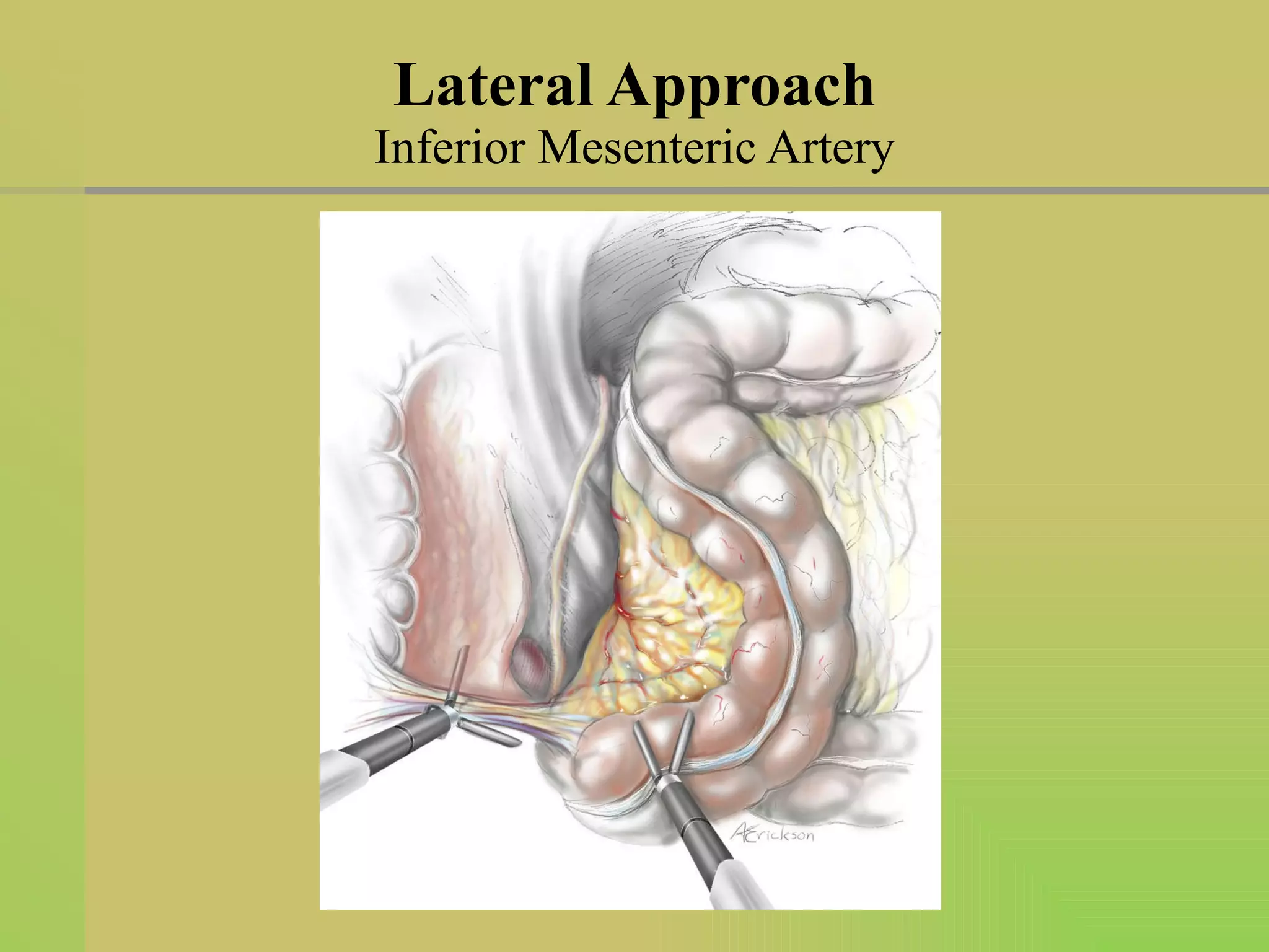 Lateral Approach Inferior Mesenteric Artery 