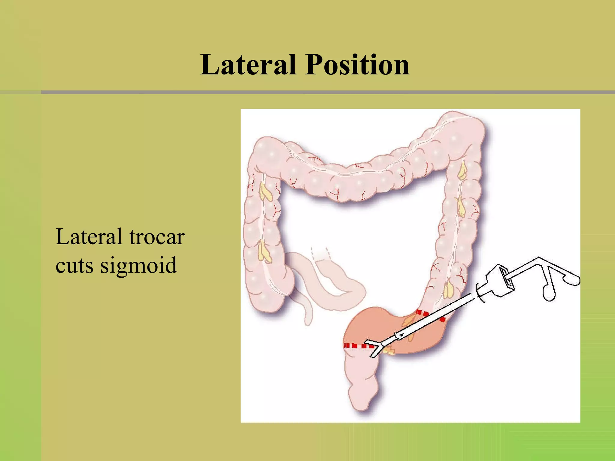 Lateral Position Lateral trocar  cuts sigmoid 