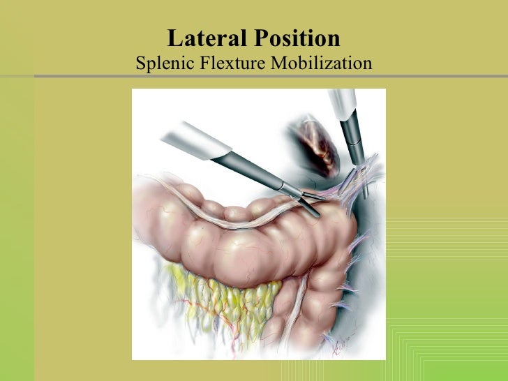 laparoscopic-sigmoid-colon-resection-supine-and-lateral