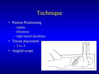 Technique Patient Positioning supine lithotomy right lateral decubitus Trocar placement 3 vs. 4 Angled scope 