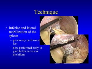 Technique Inferior and lateral mobilization of the spleen previously performed last now performed early to gain better access to the hilum 