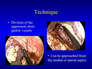 Technique Division of the uppermost short gastric vessels Can be approached from the medial or lateral aspect 