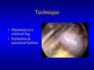 Technique Placement in a retrieval bag Extraction in piecemeal fashion  
