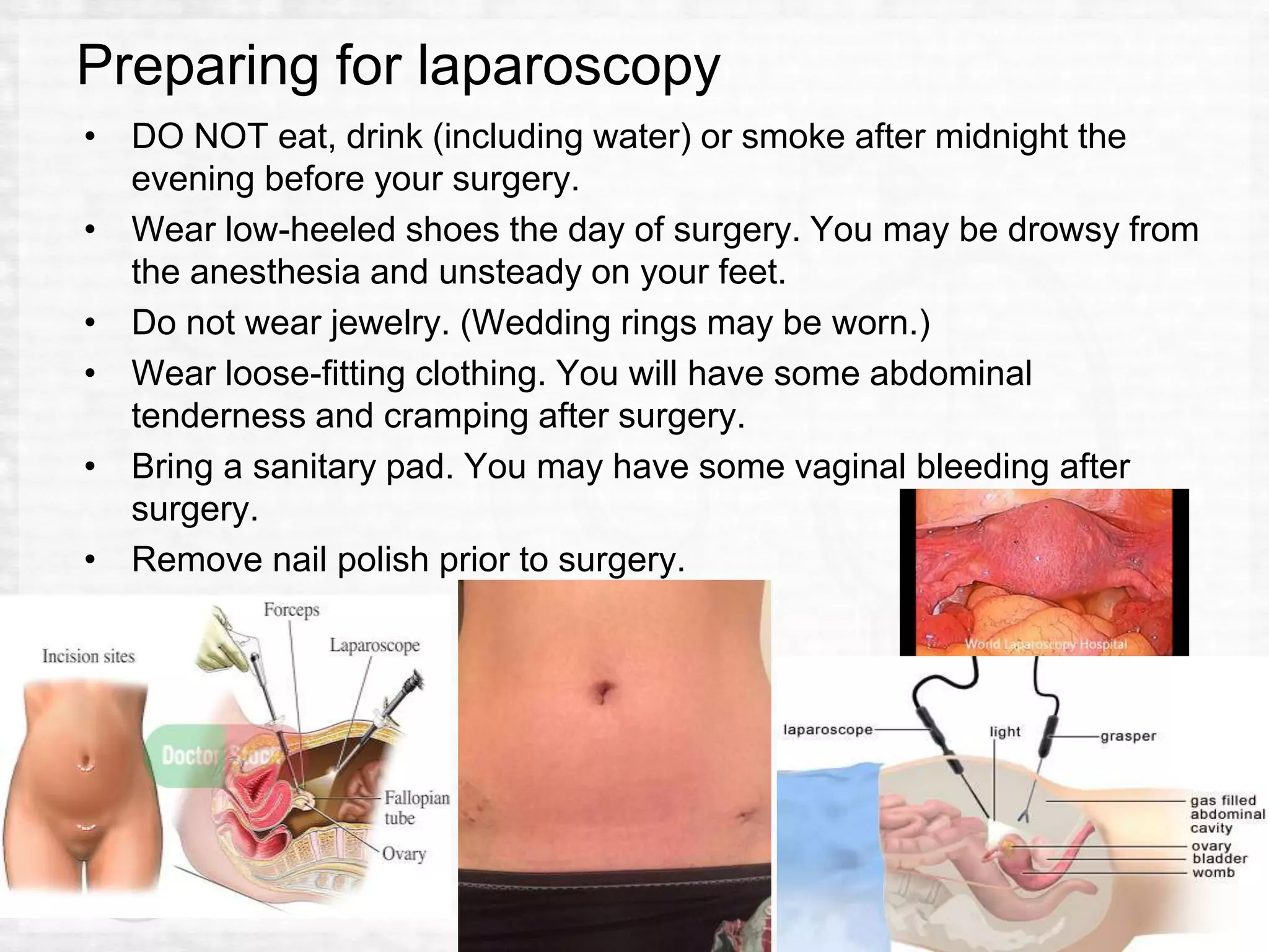 Laparoscopic sterilization my presentation | PPTX