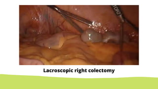 Lacroscopic right colectomy
 