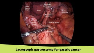 Lacroscopic gastrectomy for gastric cancer
 