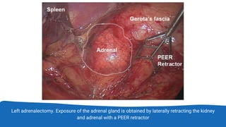 Left adrenalectomy. Exposure of the adrenal gland is obtained by laterally retracting the kidney
and adrenal with a PEER retractor
 