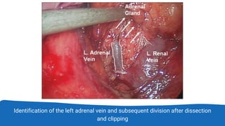 Identification of the left adrenal vein and subsequent division after dissection
and clipping
 