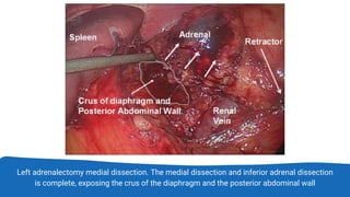 Left adrenalectomy medial dissection. The medial dissection and inferior adrenal dissection
is complete, exposing the crus of the diaphragm and the posterior abdominal wall
 