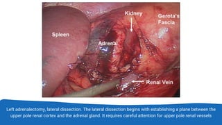 Left adrenalectomy, lateral dissection. The lateral dissection begins with establishing a plane between the
upper pole renal cortex and the adrenal gland. It requires careful attention for upper pole renal vessels
 