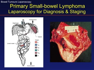 Primary Small-bowel Lymphoma Laparoscopy for Diagnosis & Staging 