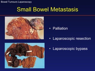 Small Bowel Metastasis Palliation Laparoscopic resection Laparoscopic bypass  