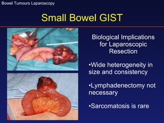 Small Bowel GIST Biological Implications for Laparoscopic Resection Wide heterogeneity in size and consistency Lymphadenectomy not necessary Sarcomatosis is rare 