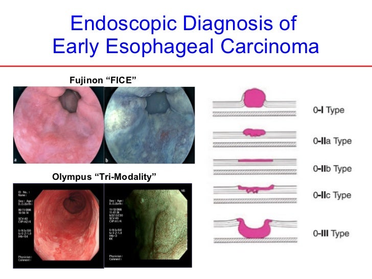 Laparoscopic trans hiatal esophagectomy for early cancerfinal