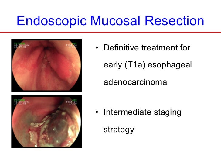 Laparoscopic trans hiatal esophagectomy for early cancerfinal