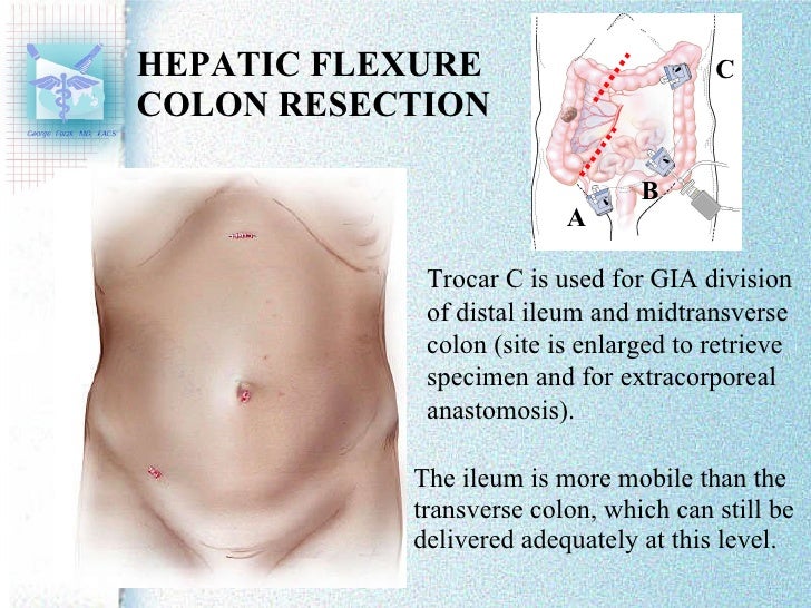 Laparoscopic Trocar Placement