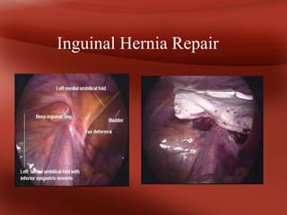 LAPAROSCOPY Origin: Greek Lapara- the soft parts of the body between the  rib margins and hips- the flank or loin  Skopein, which means to see or  view. - ppt download