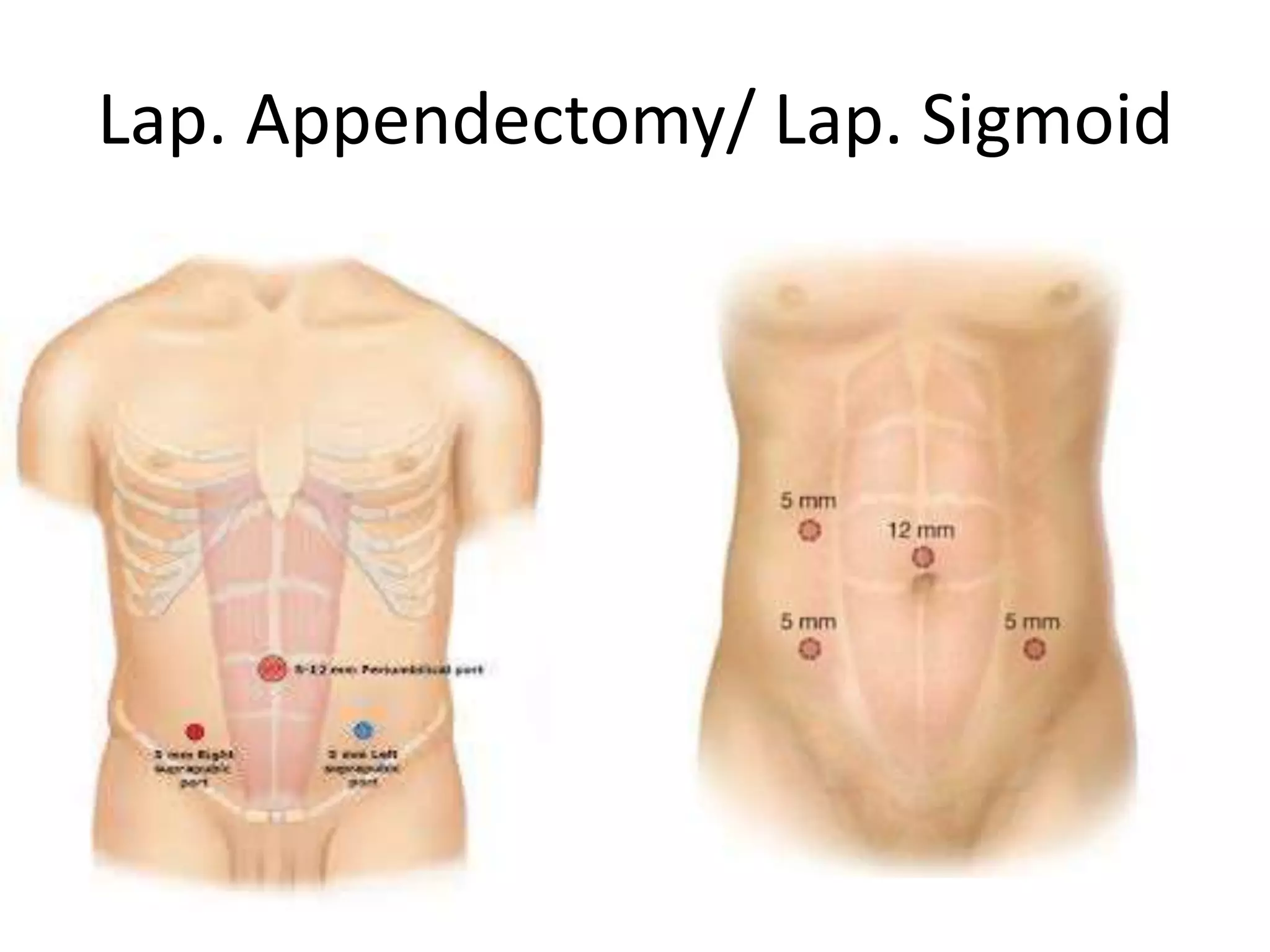 Basic of Laparoscopy | PPTX