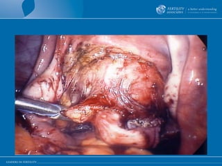 Wide excision of deep endometriosis  from vagina 