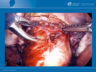 Excision of D I E from rectum 