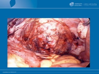Suturing of vaginal opening 
