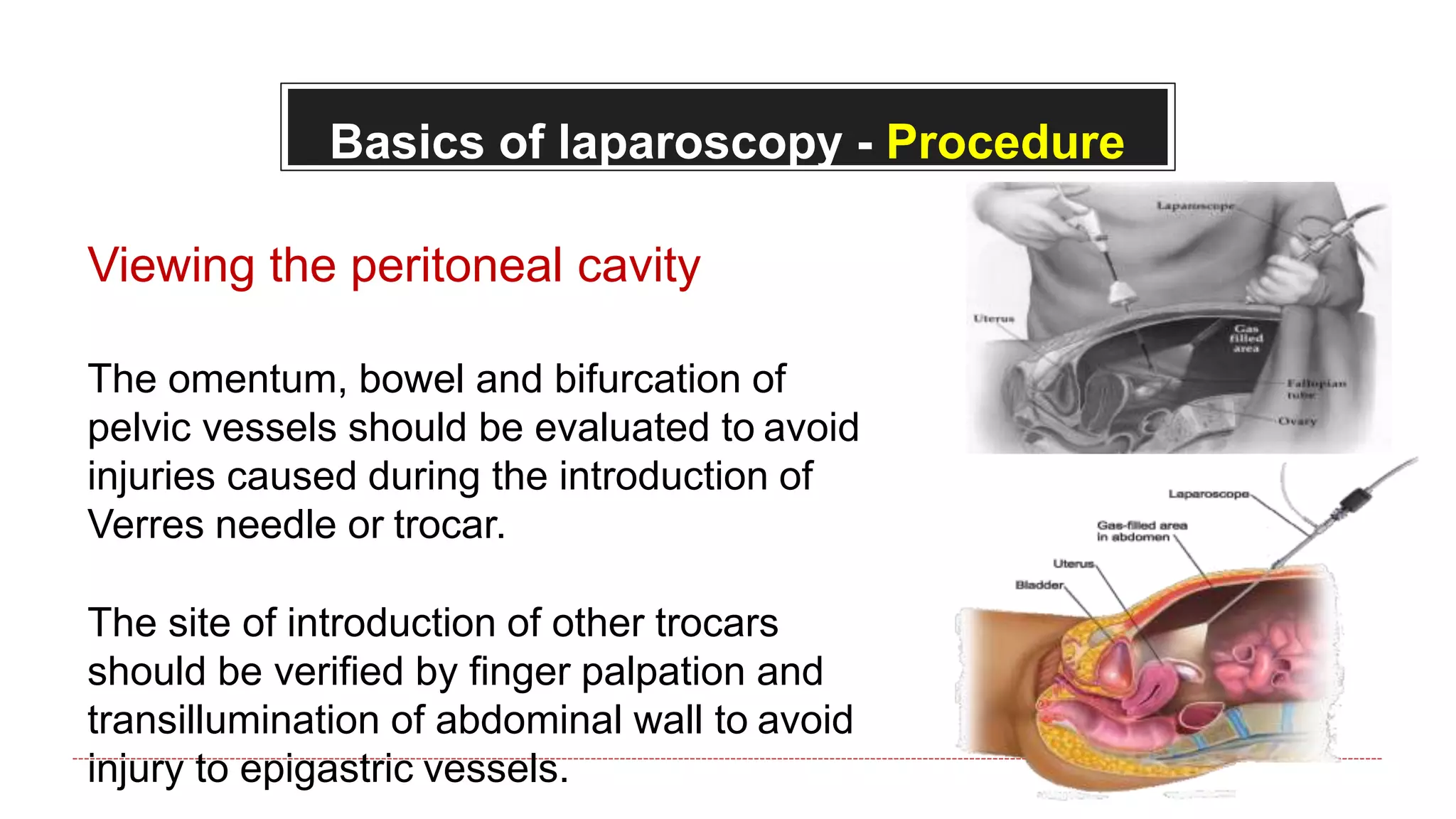 Basics of laparoscopy - Procedure
Viewing the peritoneal cavity
The omentum, bowel and bifurcation of
pelvic vessels should be evaluated to avoid
injuries caused during the introduction of
Verres needle or trocar.
The site of introduction of other trocars
should be verified by finger palpation and
transillumination of abdominal wall to avoid
injury to epigastric vessels.
 