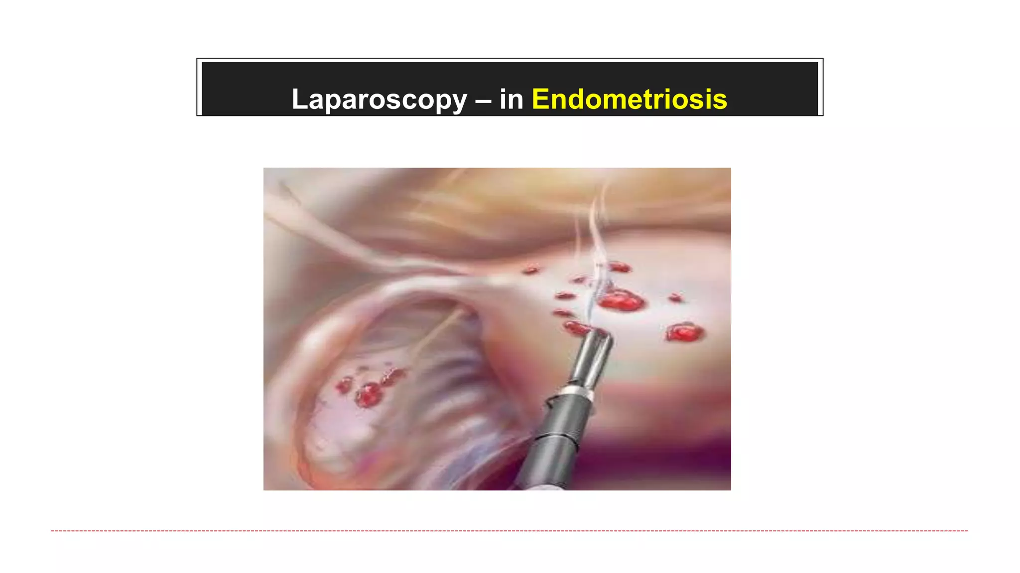 Laparoscopy – in Endometriosis
 