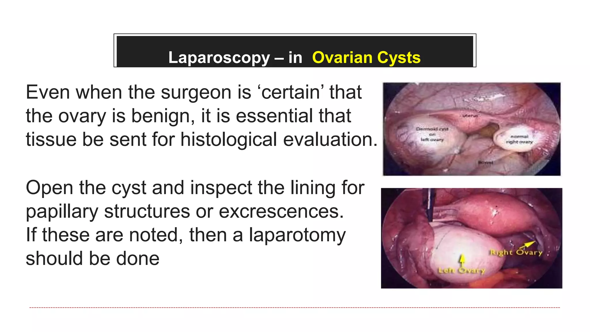 Laparoscopy – in Ovarian Cysts
Even when the surgeon is ‘certain’ that
the ovary is benign, it is essential that
tissue be sent for histological evaluation.
Open the cyst and inspect the lining for
papillary structures or excrescences.
If these are noted, then a laparotomy
should be done
 