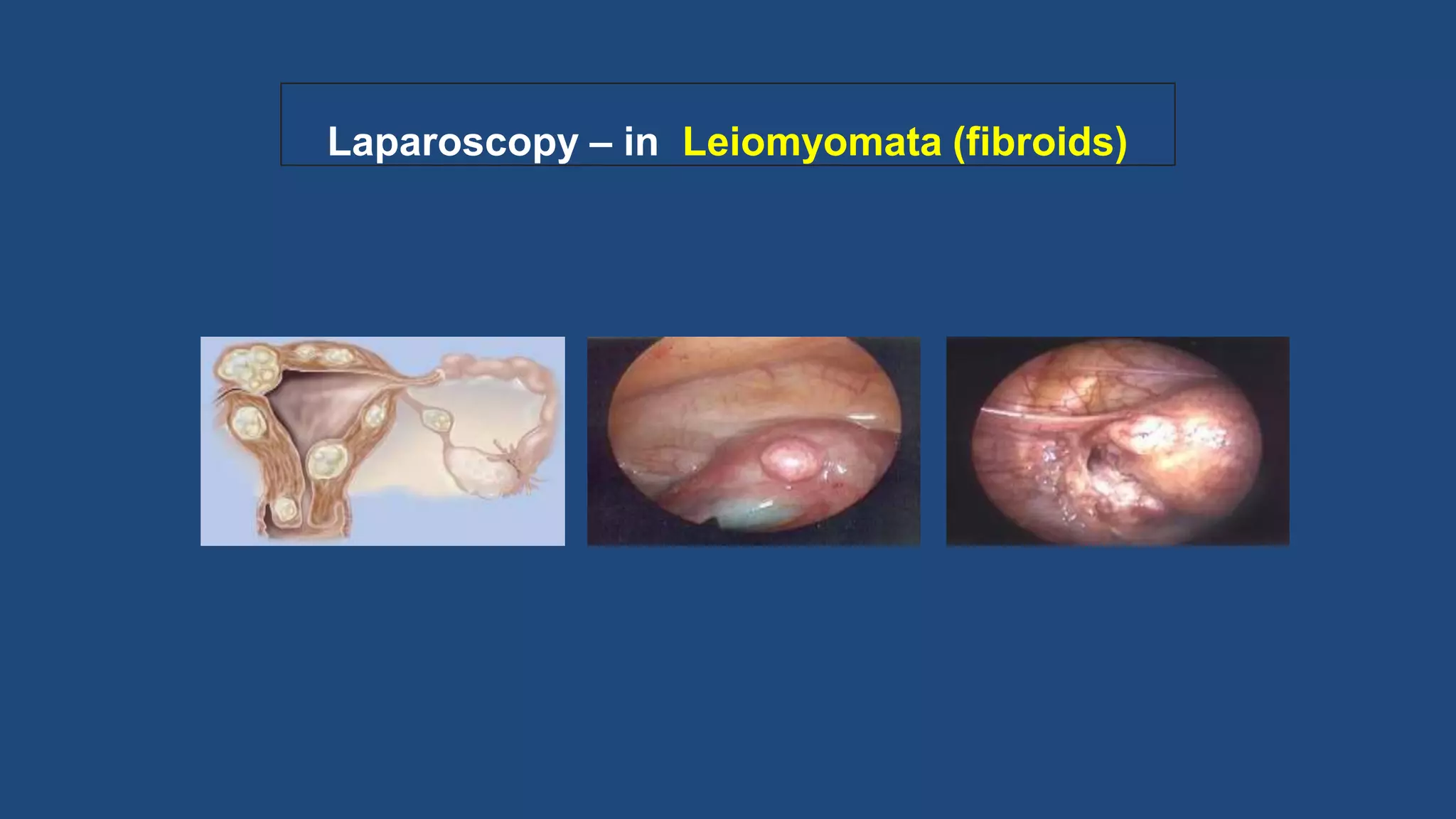 Laparoscopy – in Leiomyomata (fibroids)
 